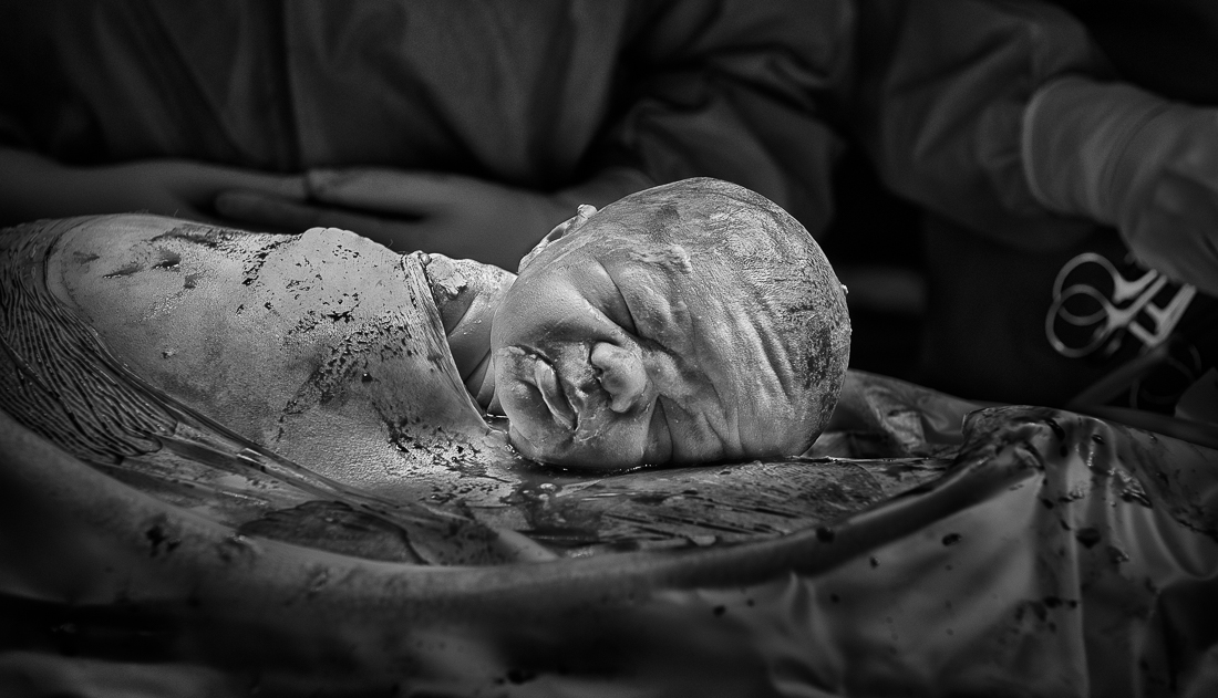 Gentle Caesarean Birth