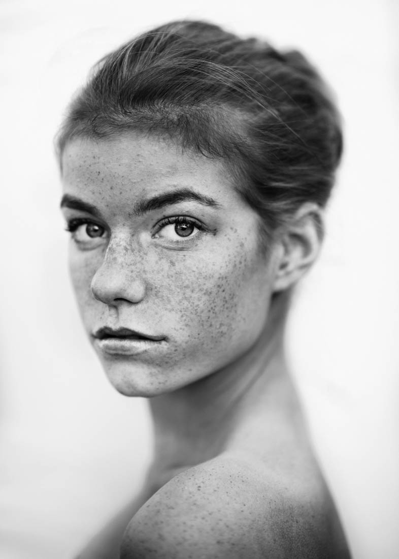 Freckles