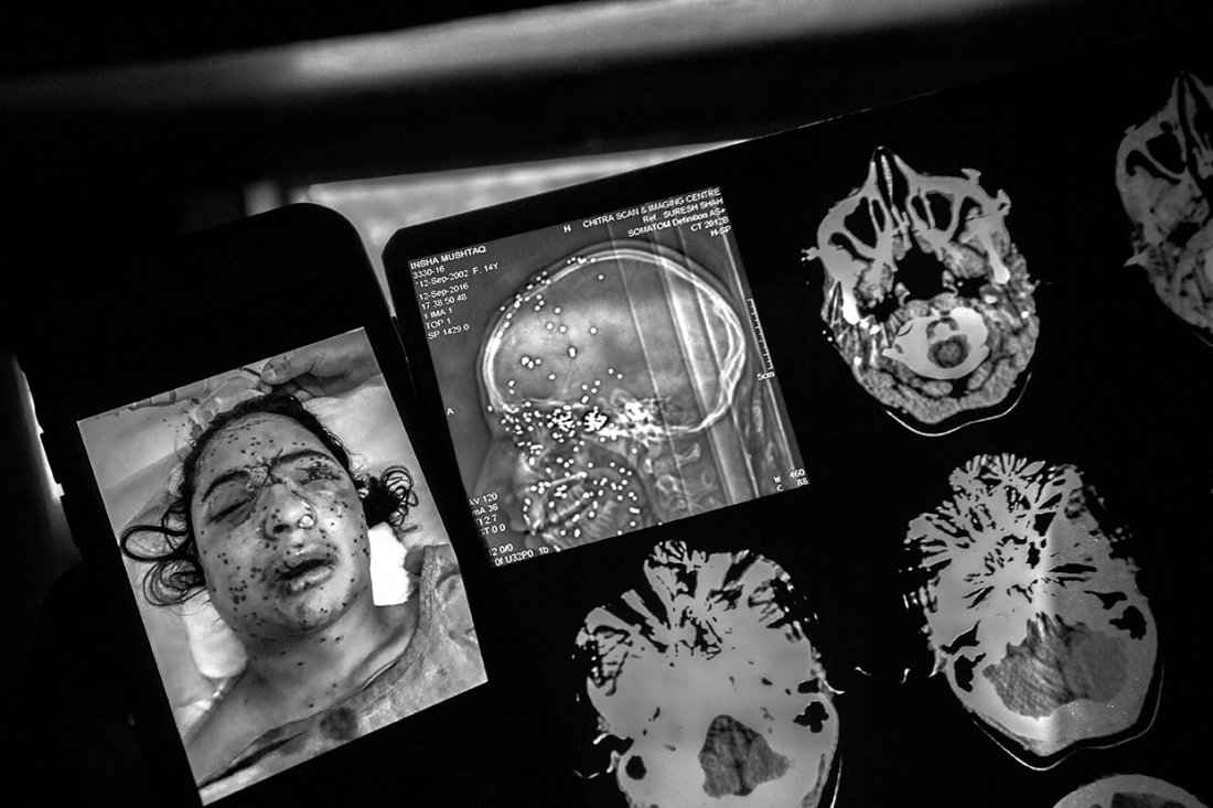 Life after being shot by over 100 pellets