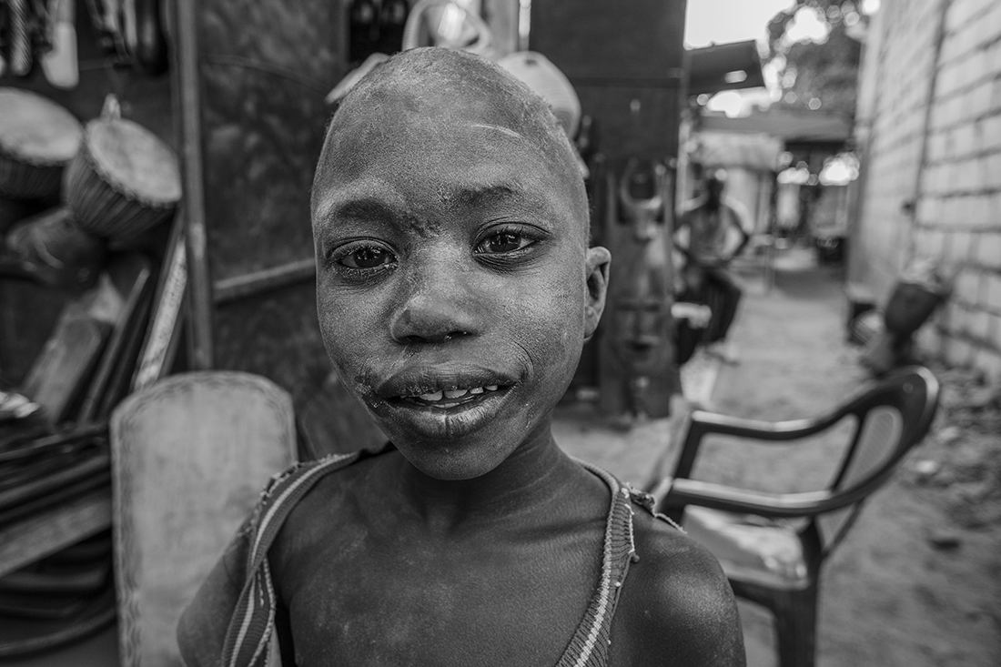 Living in a leprosy village