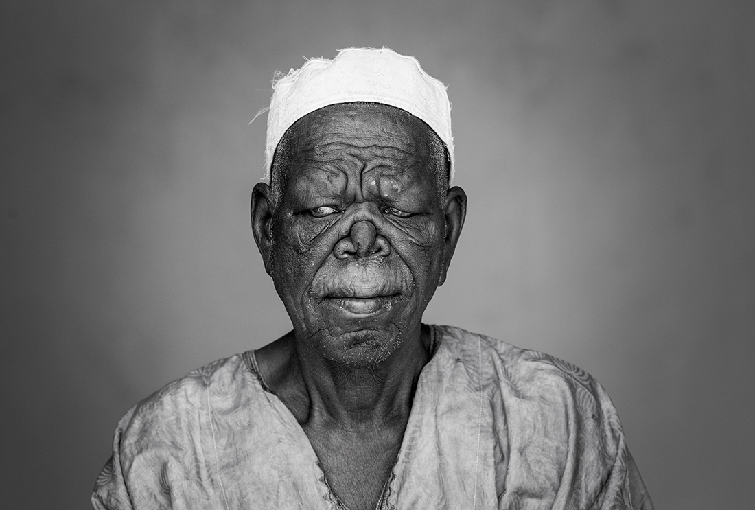 Living in a leprosy village