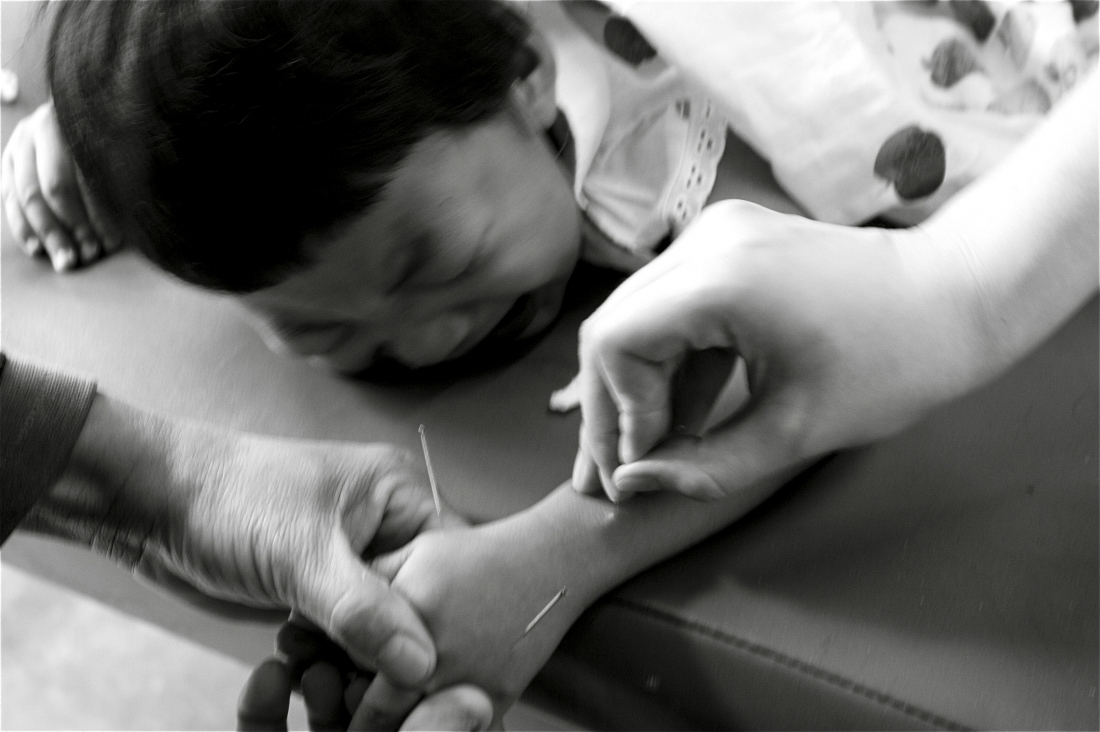 Acupuncture