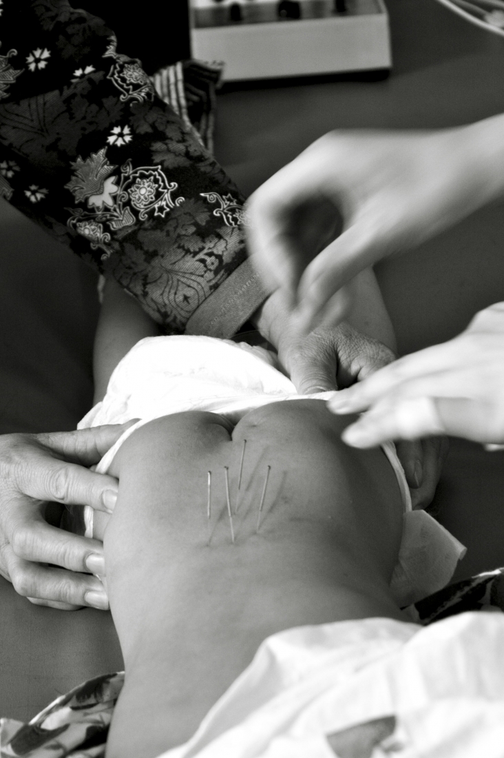 Acupuncture