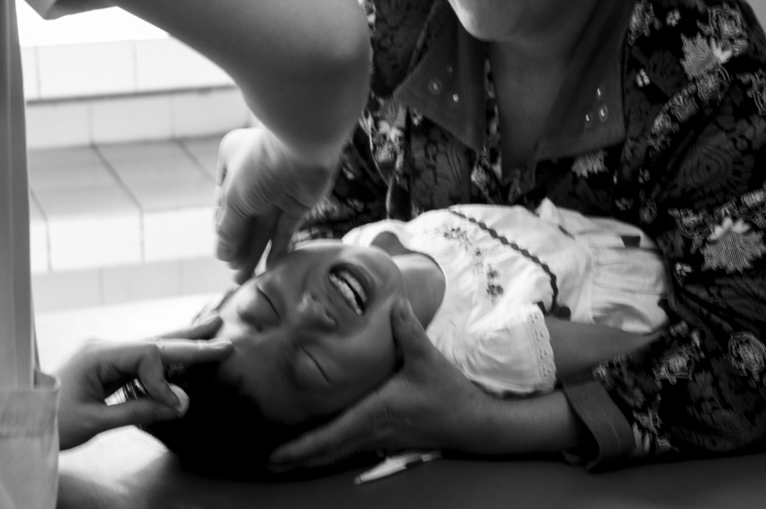 Acupuncture