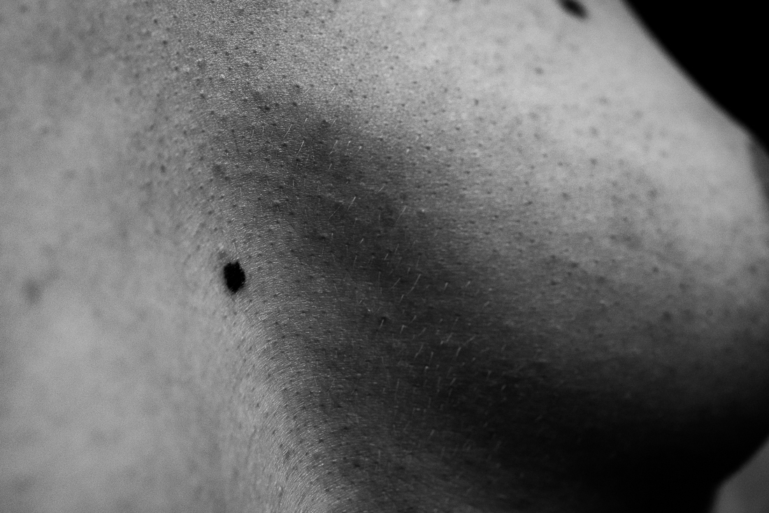 Scars