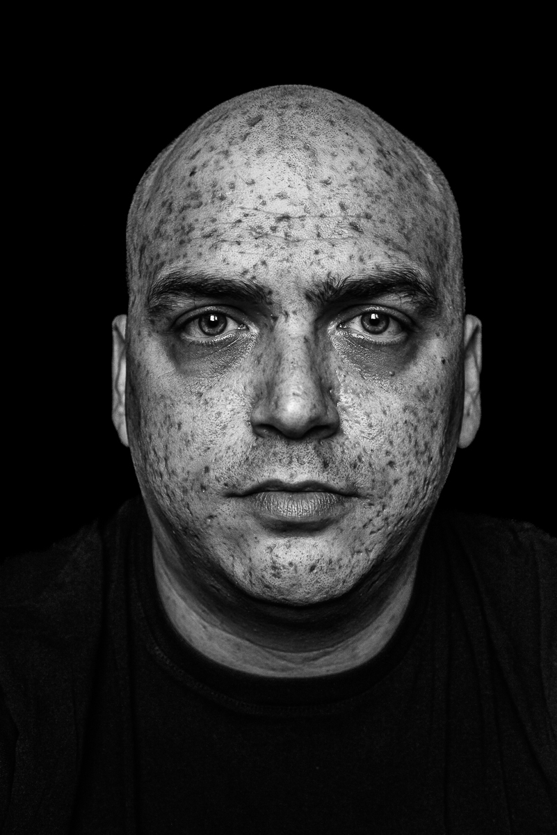 VARICELLA.